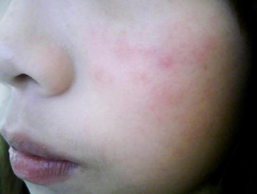 梦见脸上长红斑